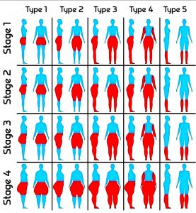 To help identify the types and stages of Lipoedema