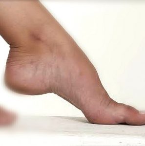 A high foot arch